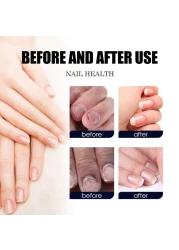 Plant Drops - Plant Drops for Nails Care, Oregano Tea Tree, Tea Tree and Oregano Oil for Toenail 10 ml/0.34 Fl.oz