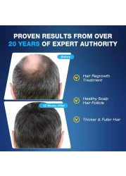 5% Minoxidil for Men Foam Hair Growth - Minoxidil Foam Hair Regrowth Treatment for Men, Topical Minoxidil Hair Loss Treatments for Men, Extra Strength Thicker &amp; Fuller Hair, 1 Month Supply, 2.11 oz