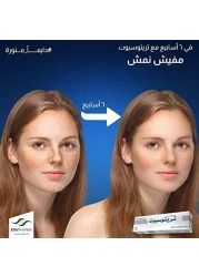 Tritospot Whitening Cream for Hyperpigmentation Problems, Melasma, Scars Freckles, Pimple Marks and Dark Spots